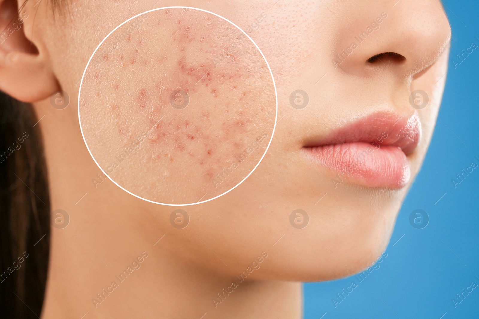 Image of Teenage girl with acne problem on blue background, closeup