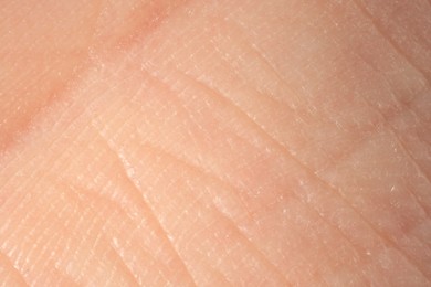 Photo of Texture of dry skin as background, macro view