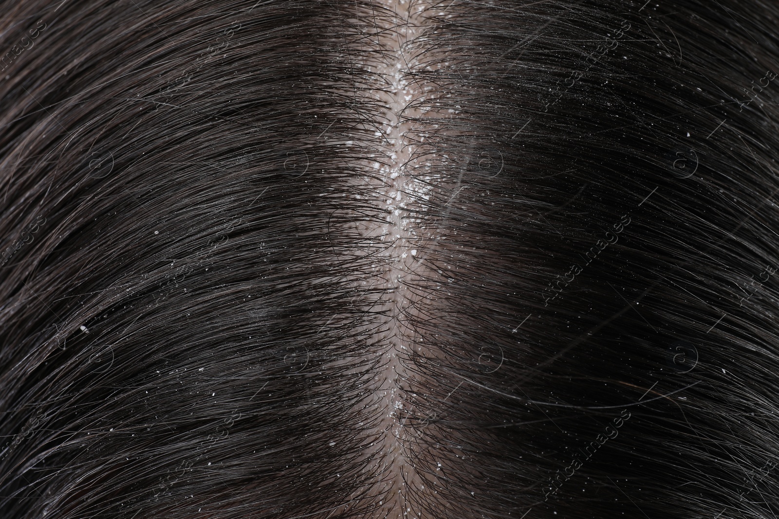 Photo of Closeup view of dark woman`s hair with dandruff