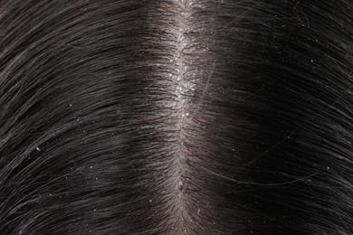 Closeup view of dark woman`s hair with dandruff