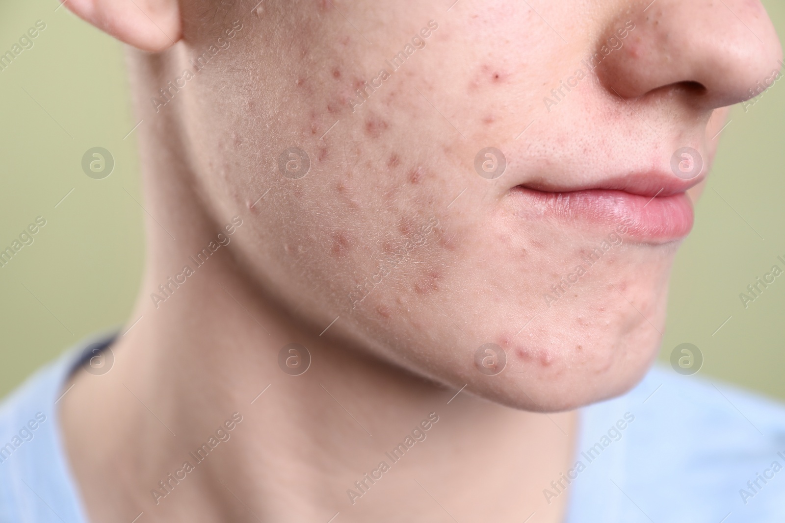 Photo of Young man with acne problem on olive background, closeup