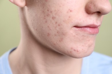 Young man with acne problem on olive background, closeup