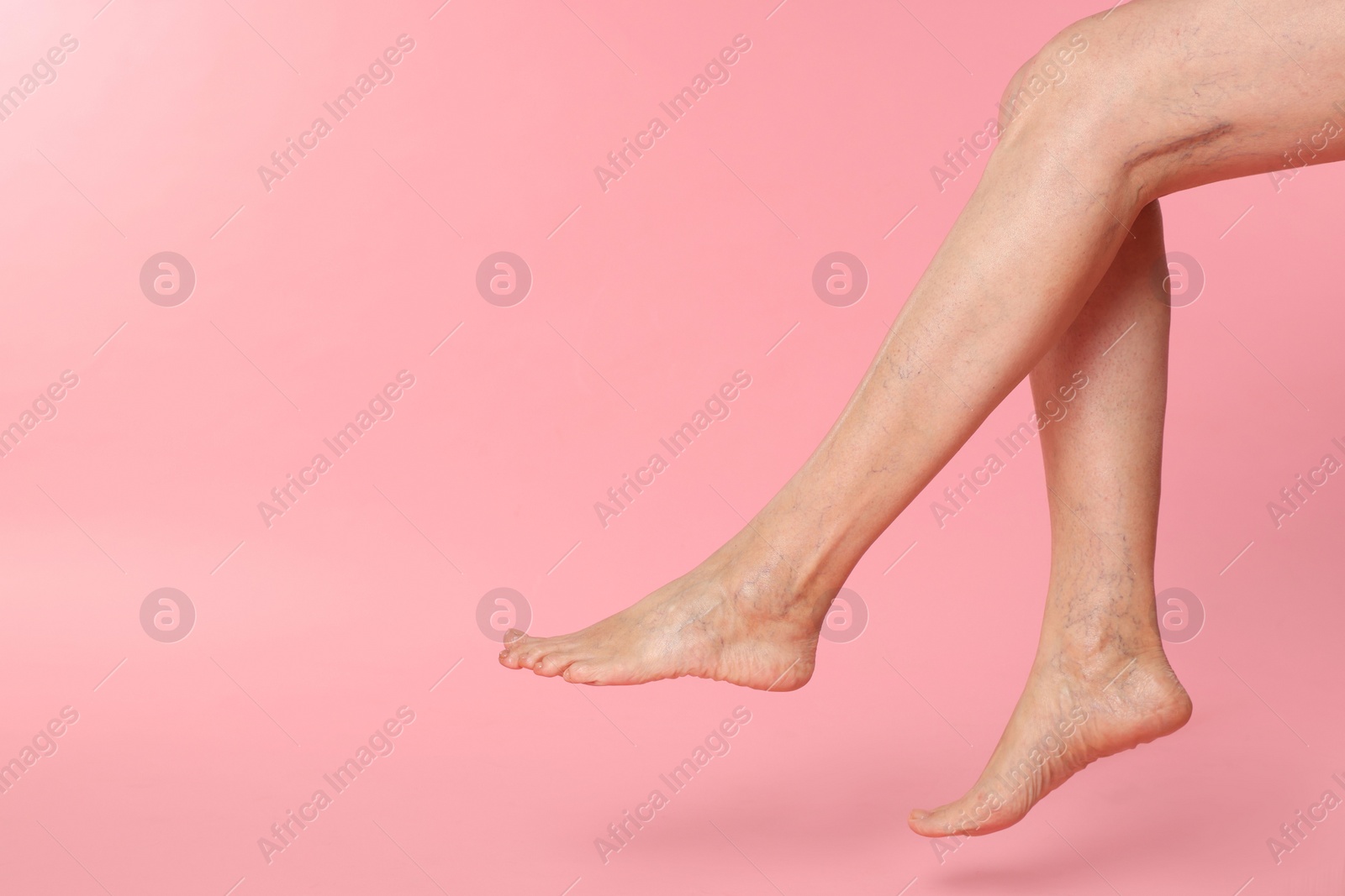 Photo of Closeup view of woman with varicose veins on pink background. Space for text