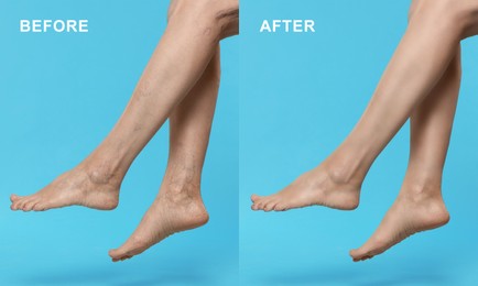 Image of Before and after varicose veins treatment. Collage with photos of woman showing legs on light blue background, closeup