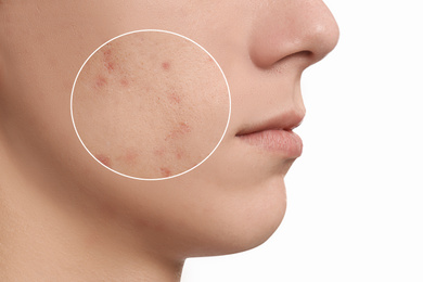 Teenage boy with acne problem on white background, closeup