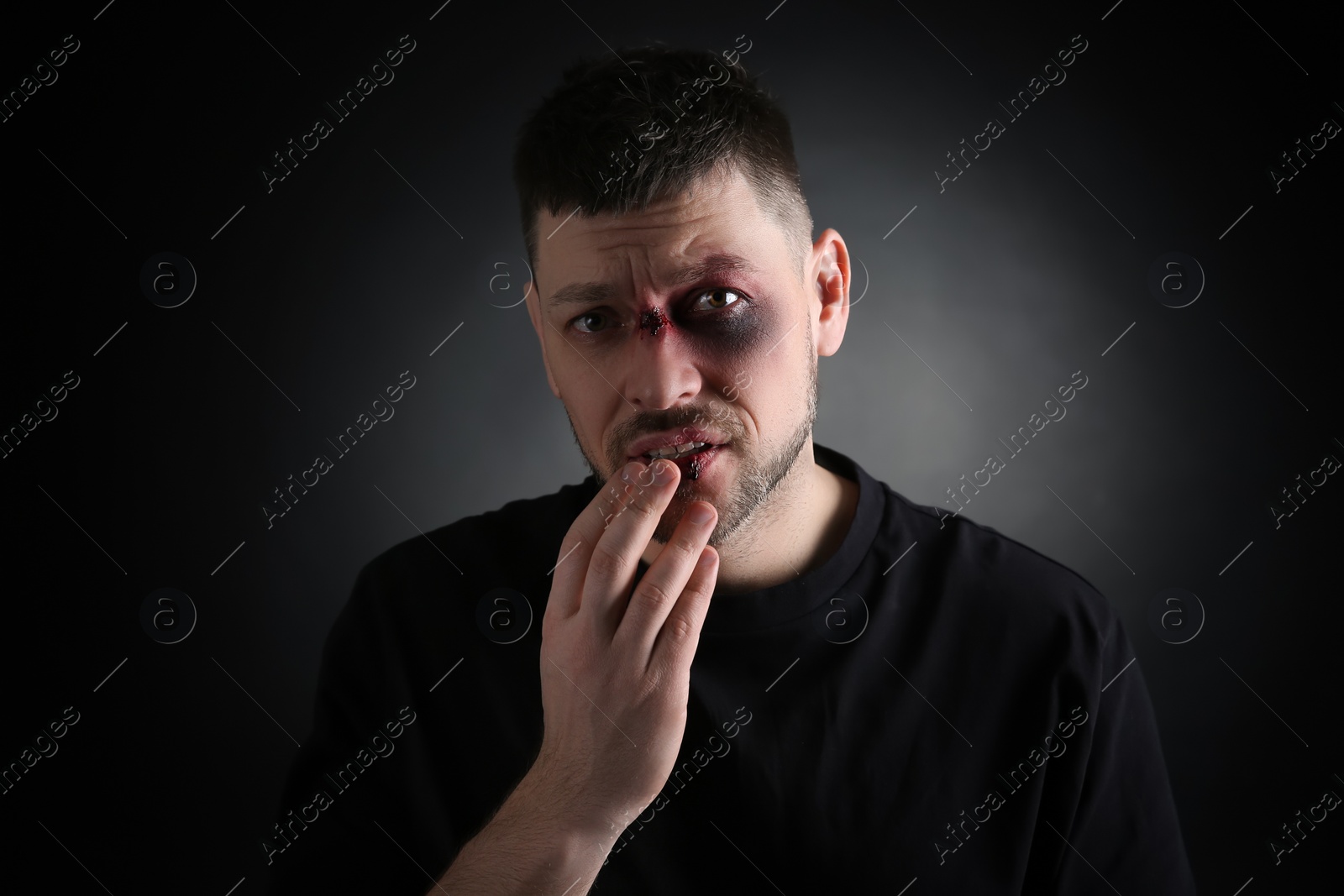 Photo of Man with facial injuries on dark background. Domestic violence victim