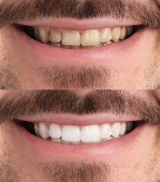 Image of Collage with photos of man before and after teeth whitening, closeup