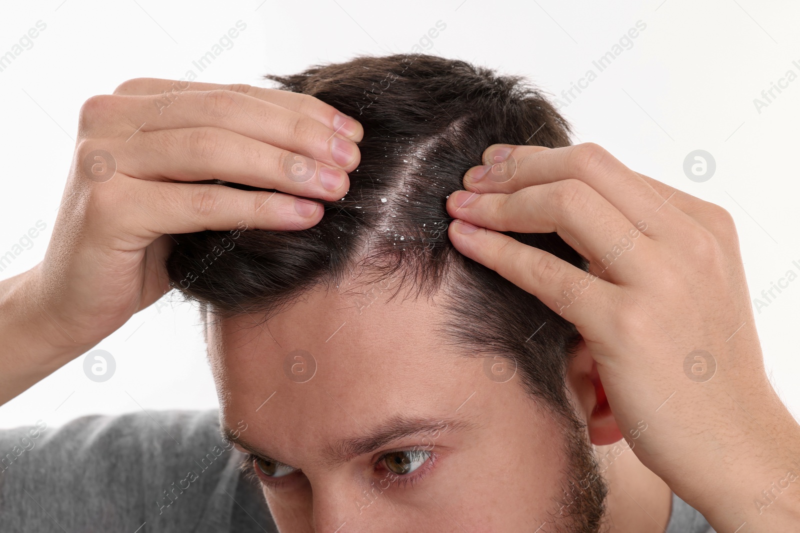 Photo of Man with dandruff in his dark hair on white background, closeup