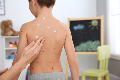 Photo of Woman applying cream onto skin of little boy with chickenpox at home, closeup