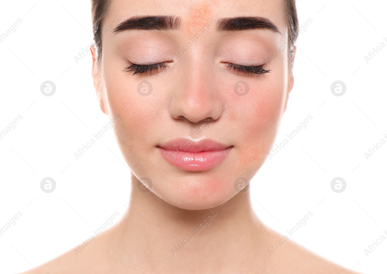 Image of Young woman with dry skin on white background