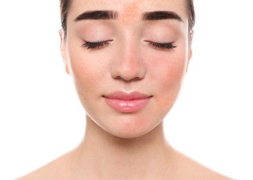 Young woman with dry skin on white background