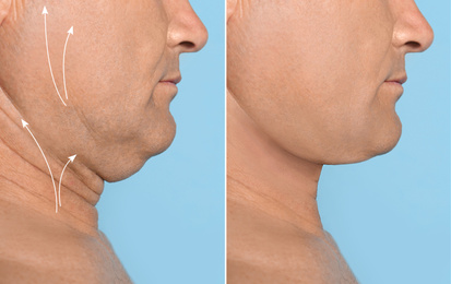 Image of Mature man before and after plastic surgery operation on blue background, closeup. Double chin problem 