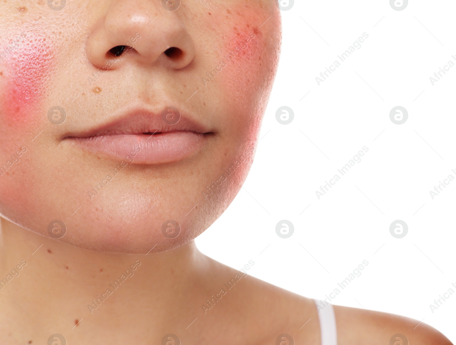 Image of Woman with rosacea on white background, closeup. Problem skin treatment