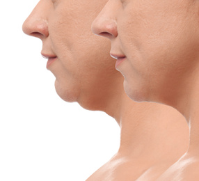 Image of Mature woman before and after plastic surgery operation on white background, closeup. Double chin problem