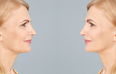Mature woman before and after cosmetic procedure on grey background 