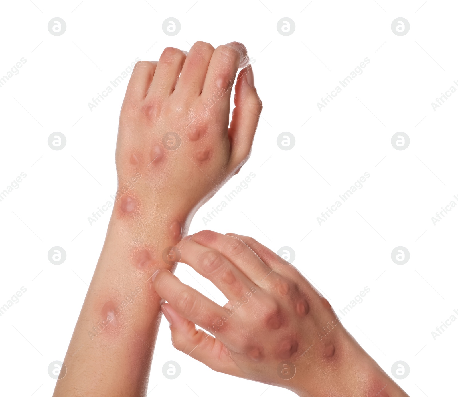 Photo of Woman with rash suffering from monkeypox virus on white background, closeup