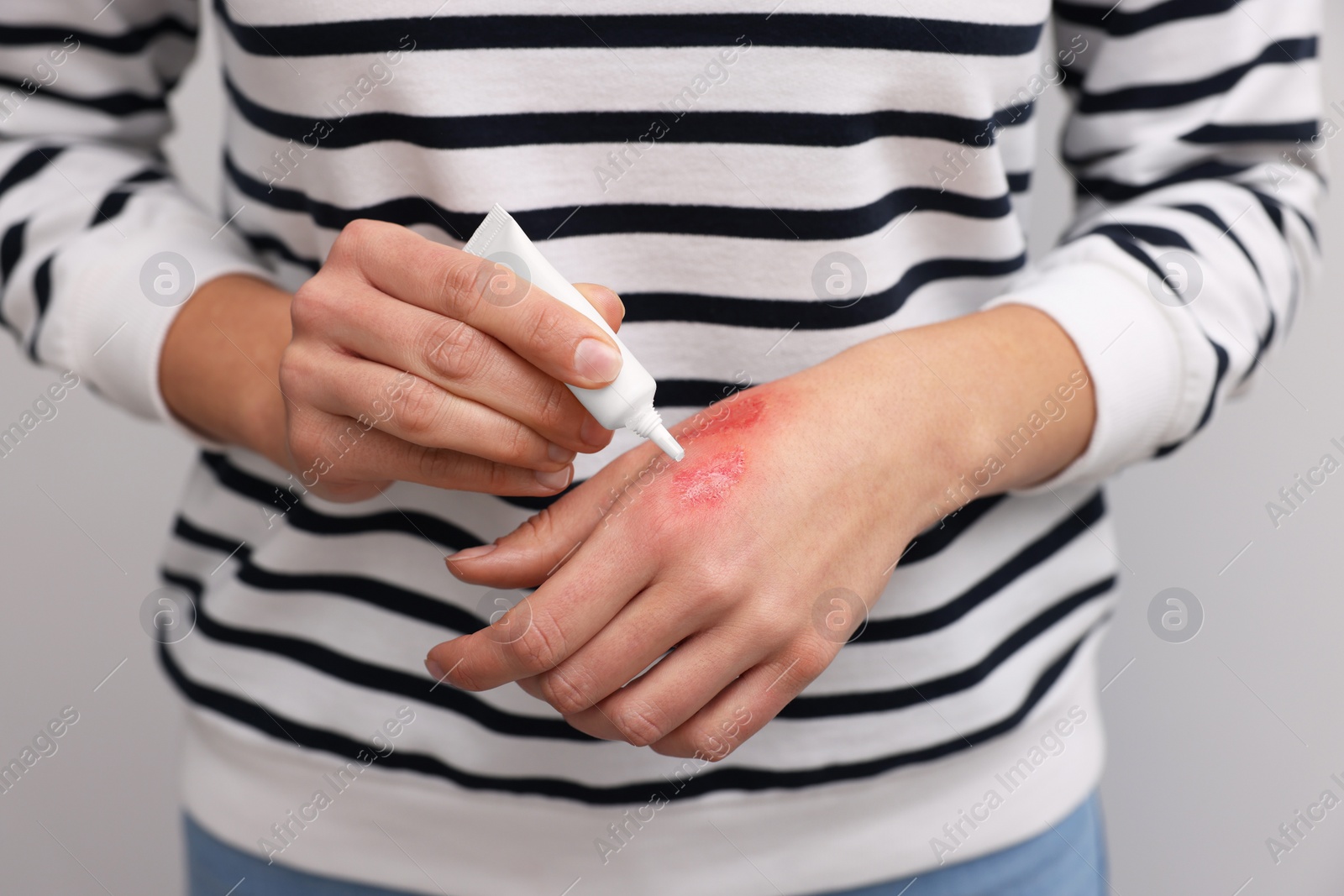 Photo of Woman applying healing cream onto burned hand on light grey background, closeup