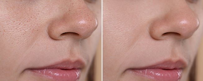 Blackhead treatment, before and after. Collage with photos of woman, closeup view