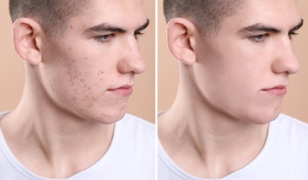 Acne problem. Young man before and after treatment on beige background, collage of photos