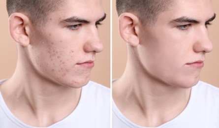 Image of Acne problem. Young man before and after treatment on beige background, collage of photos