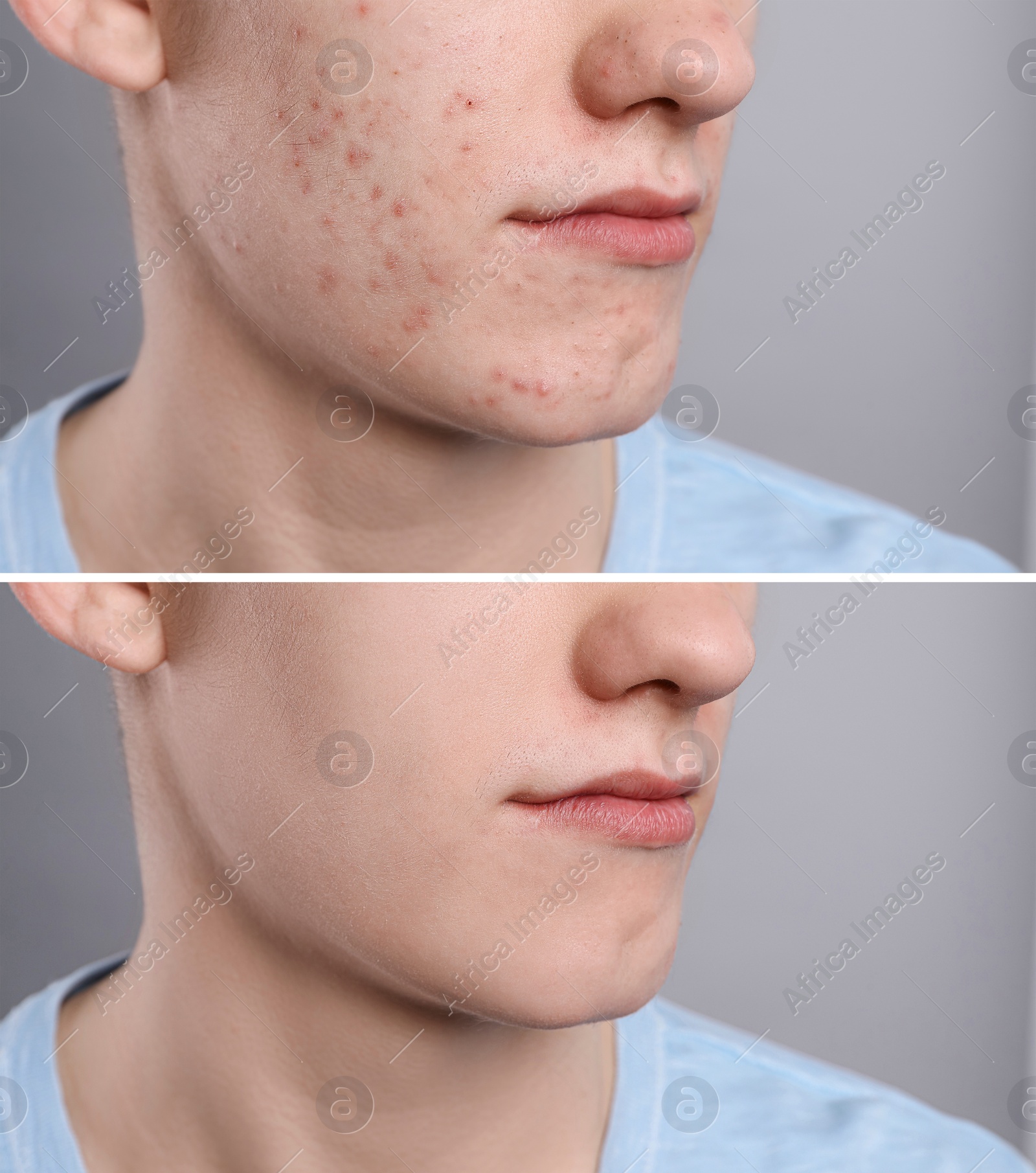 Image of Acne problem. Young man before and after treatment on grey background, closeup. Collage of photos