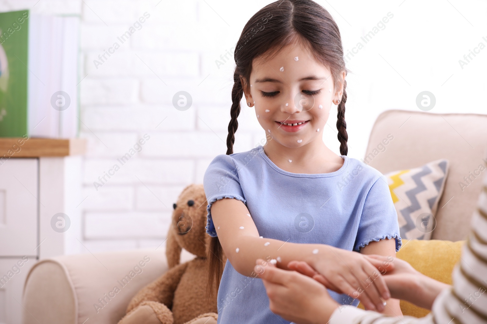 Photo of Mother applying cream onto skin of her daughter with chickenpox at home