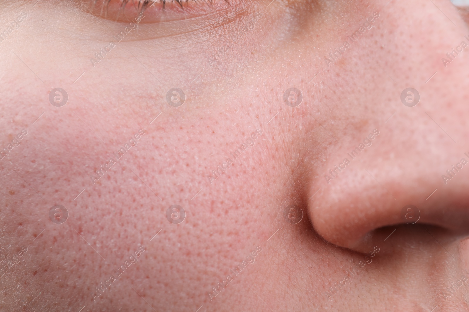 Photo of Woman with dry skin on face, closeup