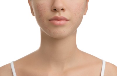 Photo of Teenage girl with acne problem on white background, closeup