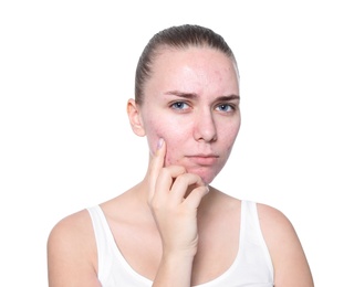 Photo of Young woman with acne problem on white background