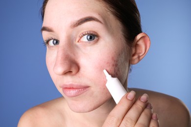 Young woman with acne problem applying cosmetic product onto her skin on blue background, closeup