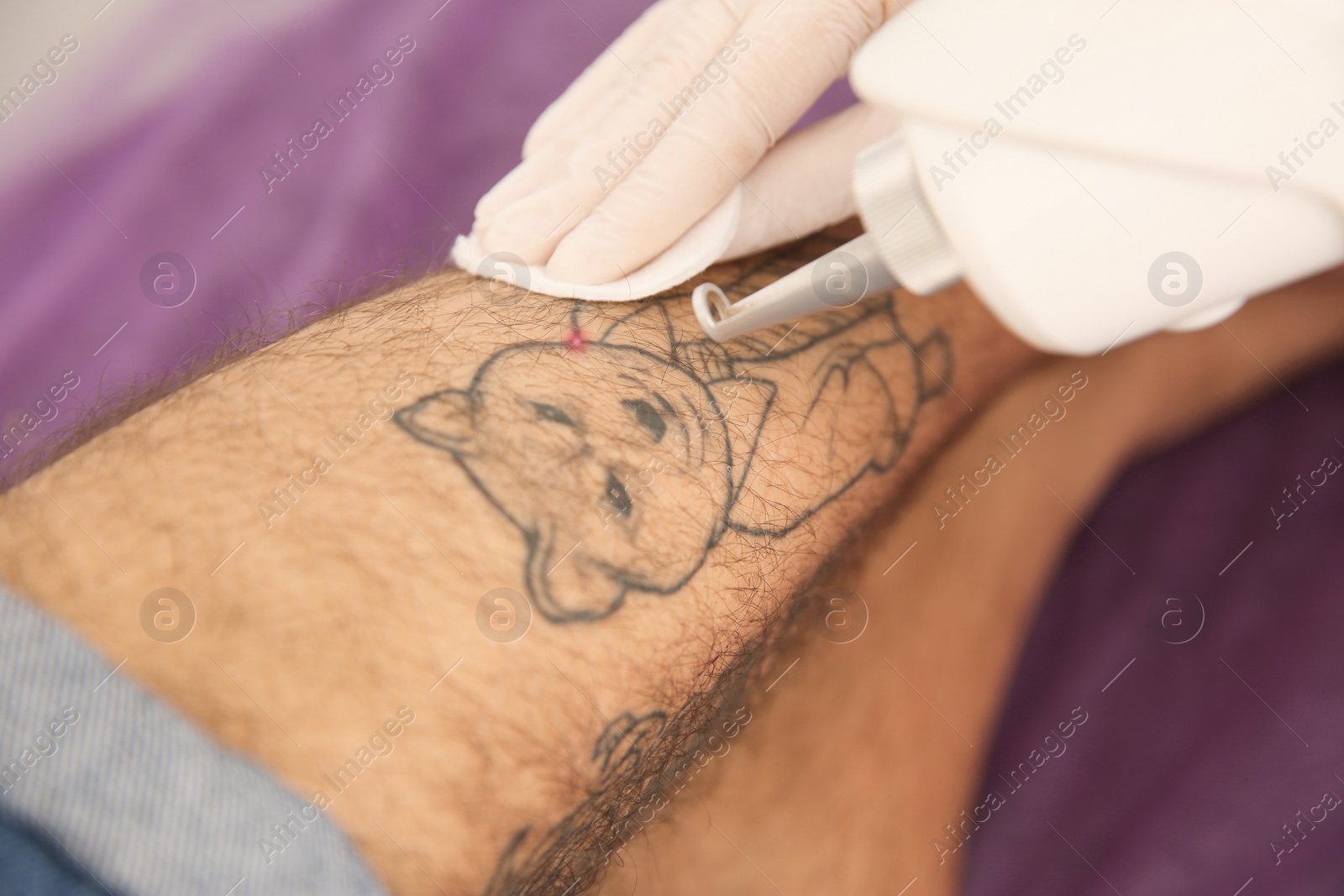 Photo of Young man undergoing laser tattoo removal procedure in salon, closeup