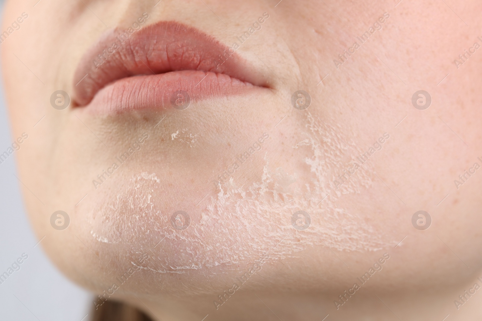 Photo of Closeup view of woman with dry skin