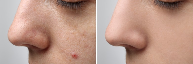 Image of Before and after acne treatment. Photos of woman on light grey background, closeup. Collage showing affected and healthy skin