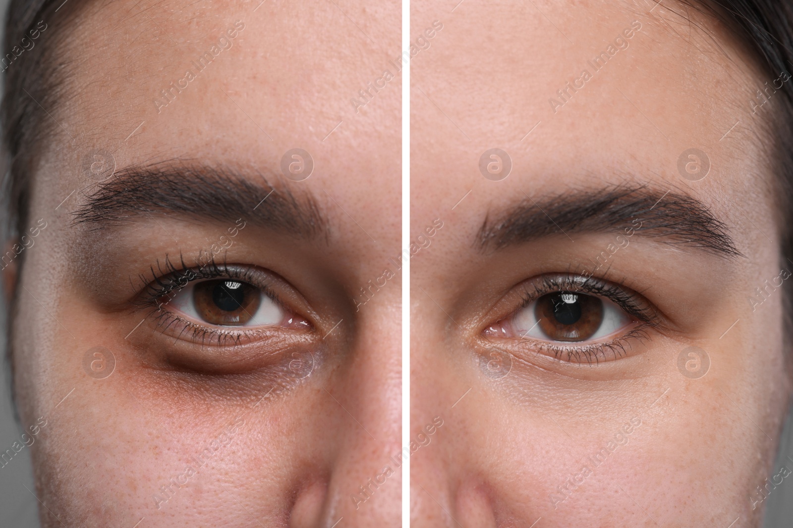 Image of Collage with photos of woman with dark circle under eye before and after treatment, closeup