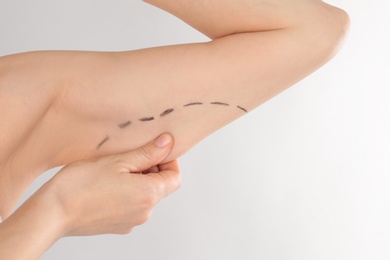 Photo of Woman with marks on arm for cosmetic surgery operation against grey background, closeup