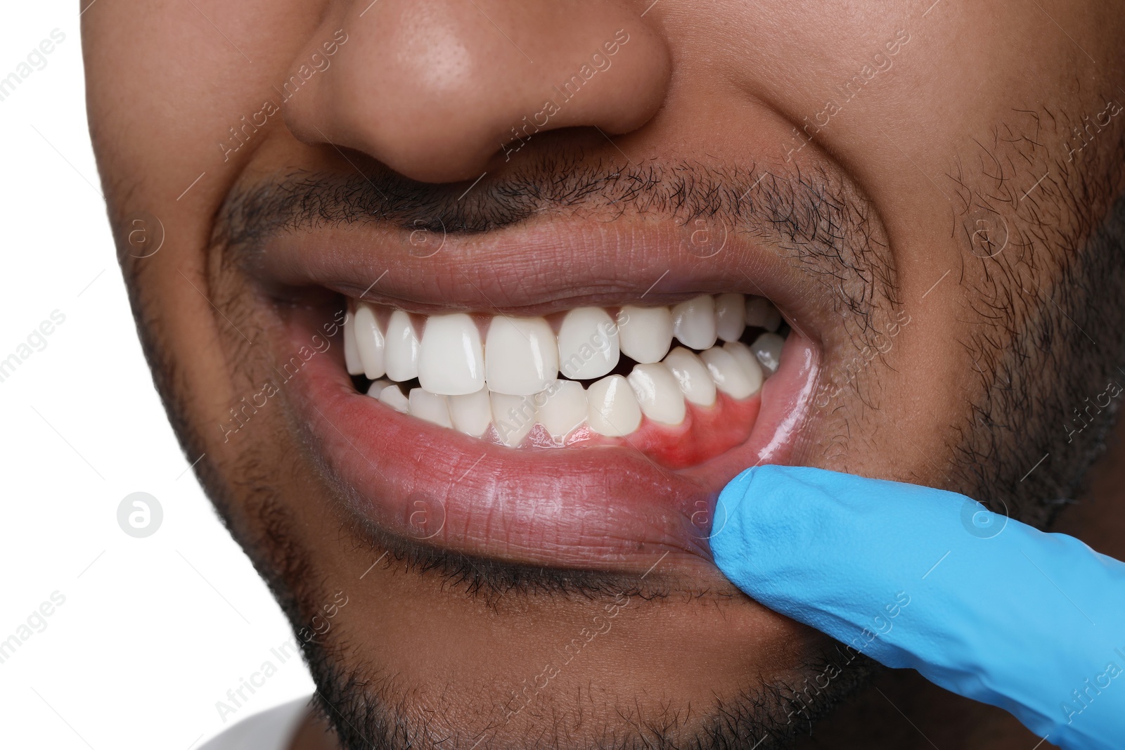 Image of Doctor examining man's inflamed gum on white background, closeup