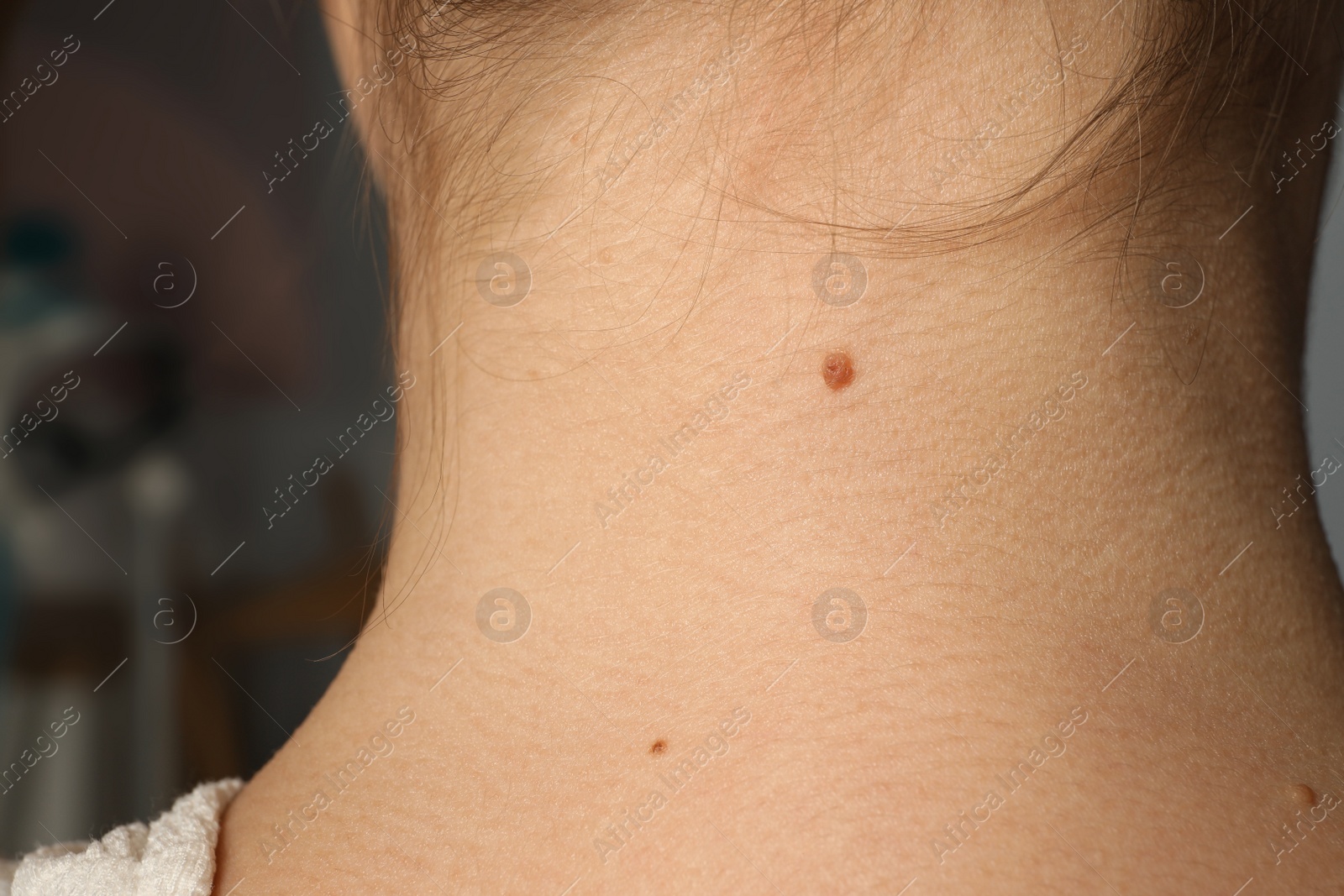 Photo of Closeup view of woman's neck with birthmarks
