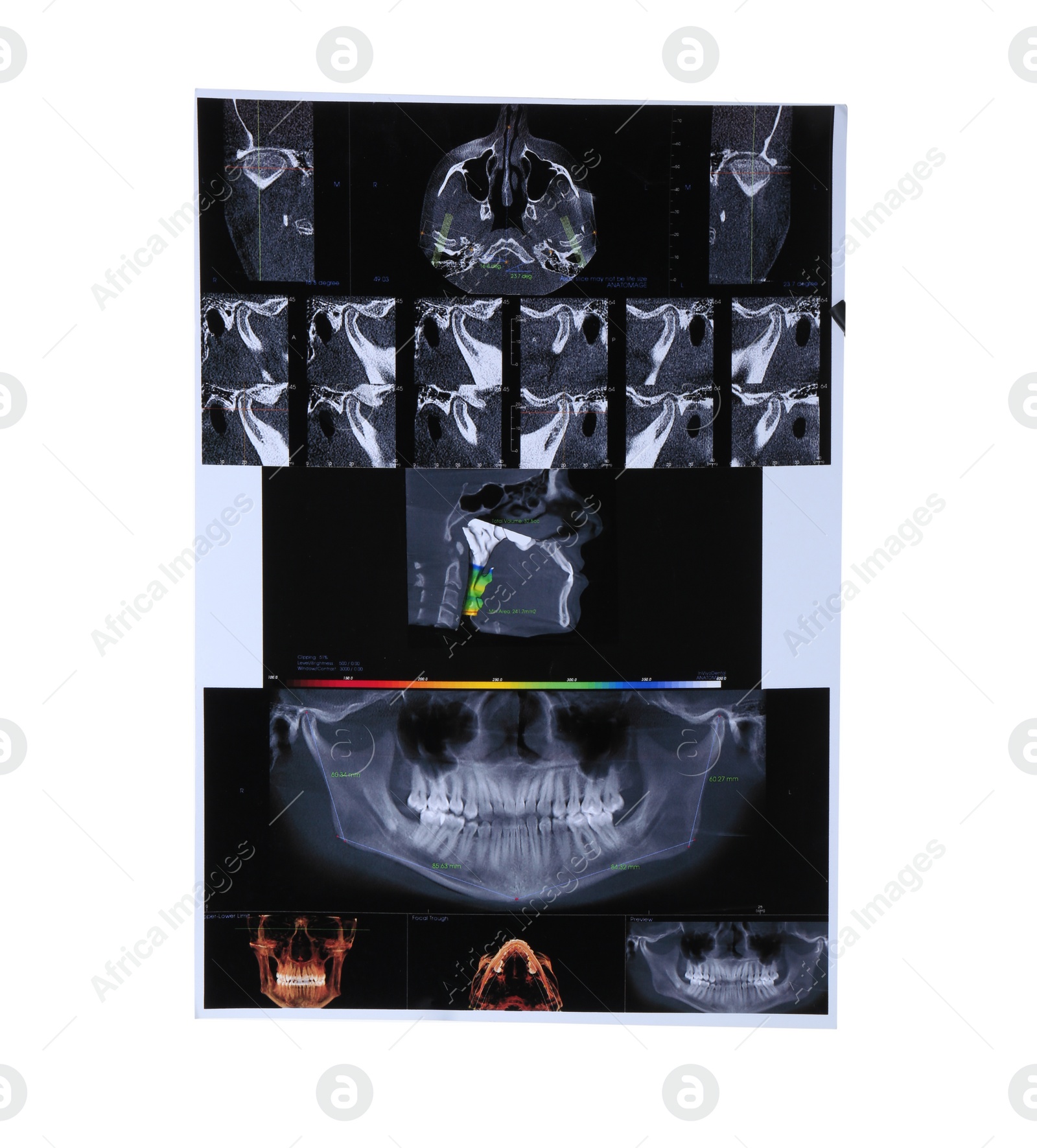 Photo of X-ray scans of human maxillofacial section for dental analysis isolated on white