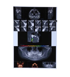 Photo of X-ray scans of human maxillofacial section for dental analysis isolated on white