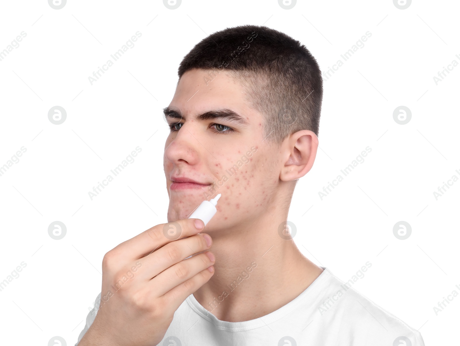 Photo of Young man with acne problem applying cosmetic product onto his skin on white background