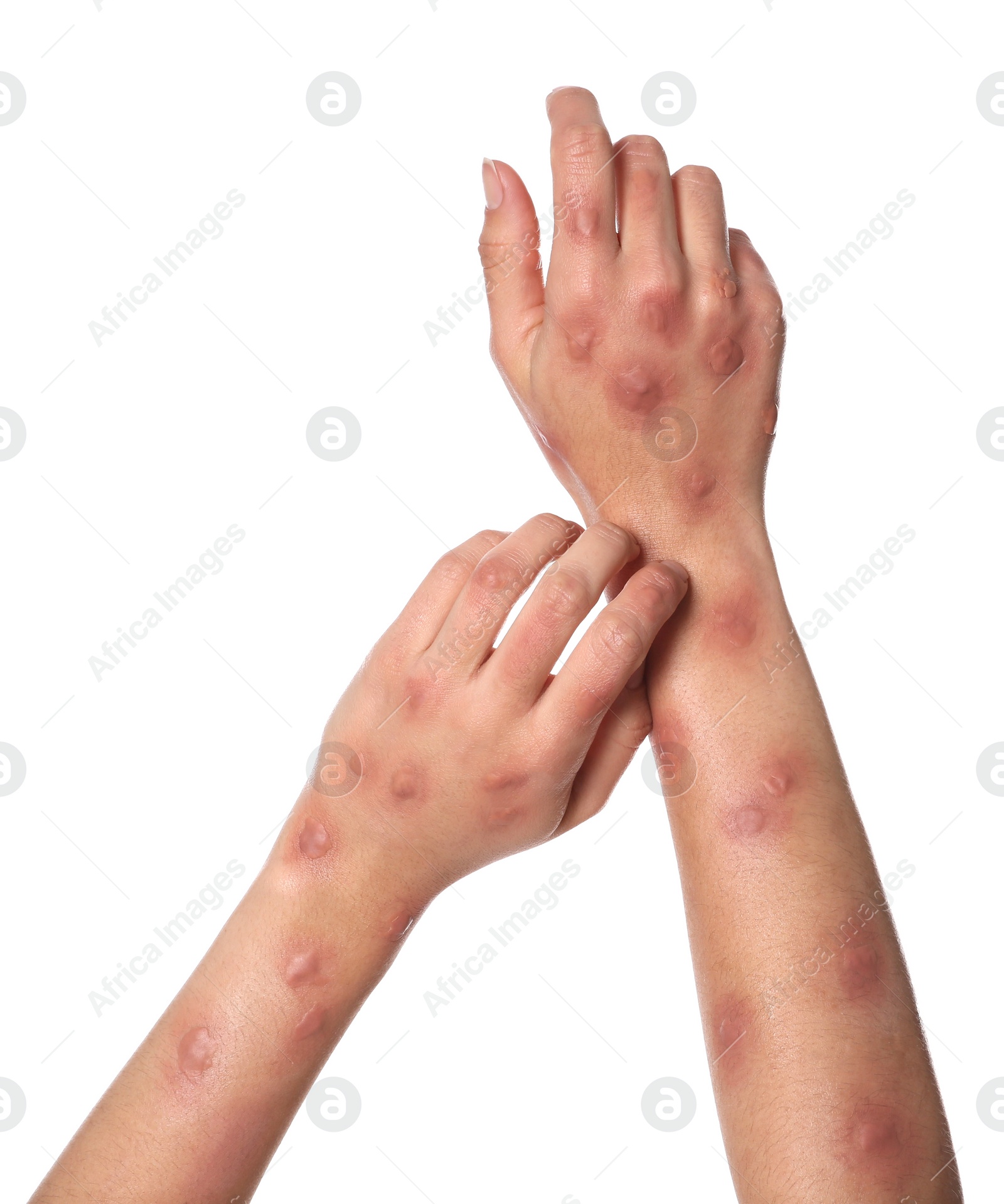 Photo of Woman with rash suffering from monkeypox virus on white background, closeup