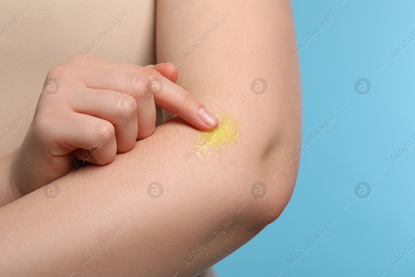 Photo of Woman applying ointment onto her arm on light blue background, closeup