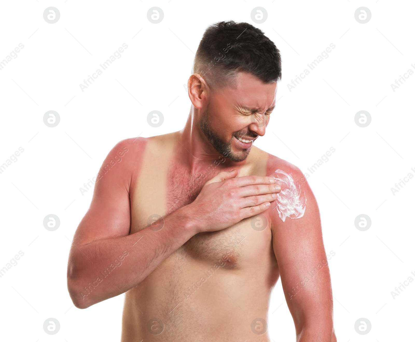 Photo of Man applying cream on sunburn against white background