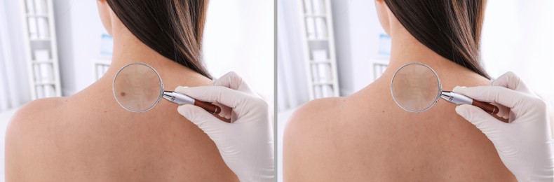 Image of Mole removal. Collage with photos of patient's back before and after procedure, closeup. Dermatologist looking at skin through magnifying glass