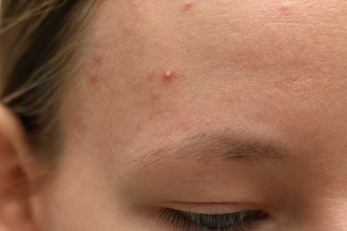 Young woman with acne on her face, closeup