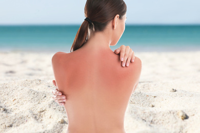 Image of Woman with sunburn on beach. Skin protection from sun in summer
