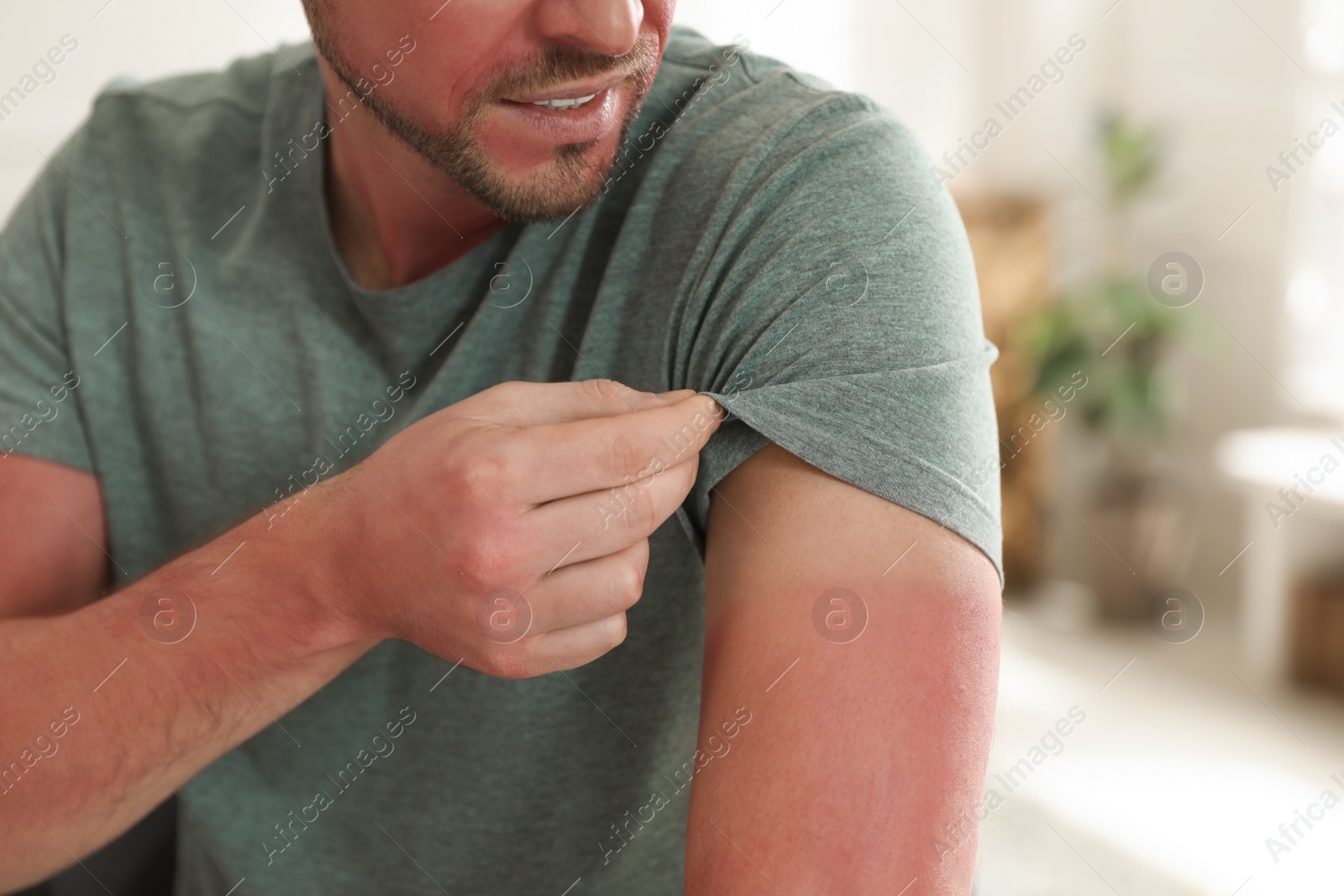 Photo of Man with sunburned skin at home, closeup