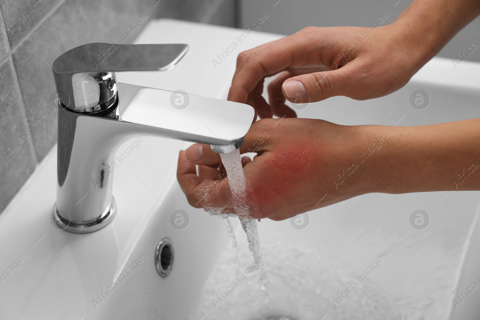 Photo of Woman holding burned hand under cold water indoors, closeup