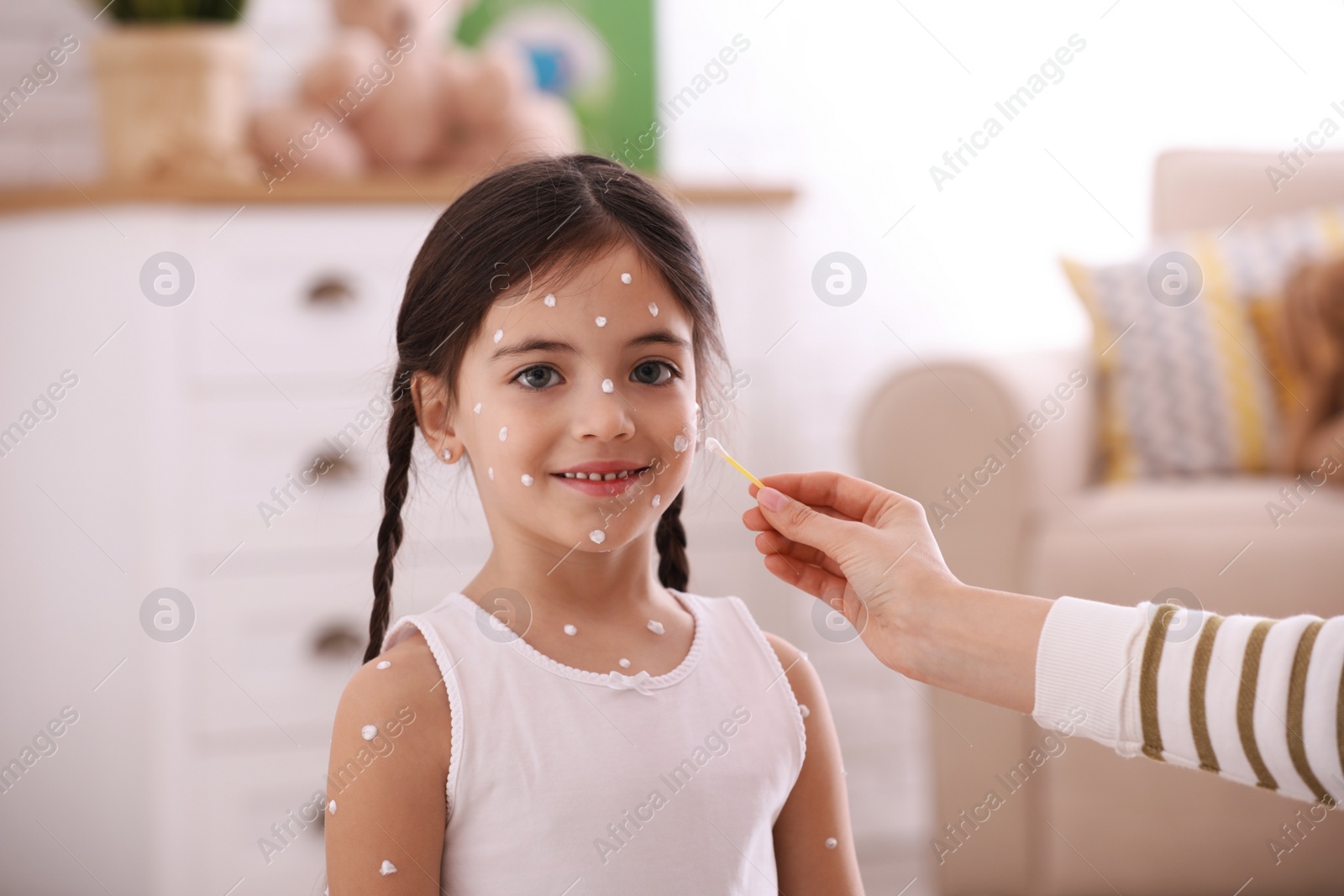 Photo of Mother applying cream onto skin of her daughter with chickenpox at home