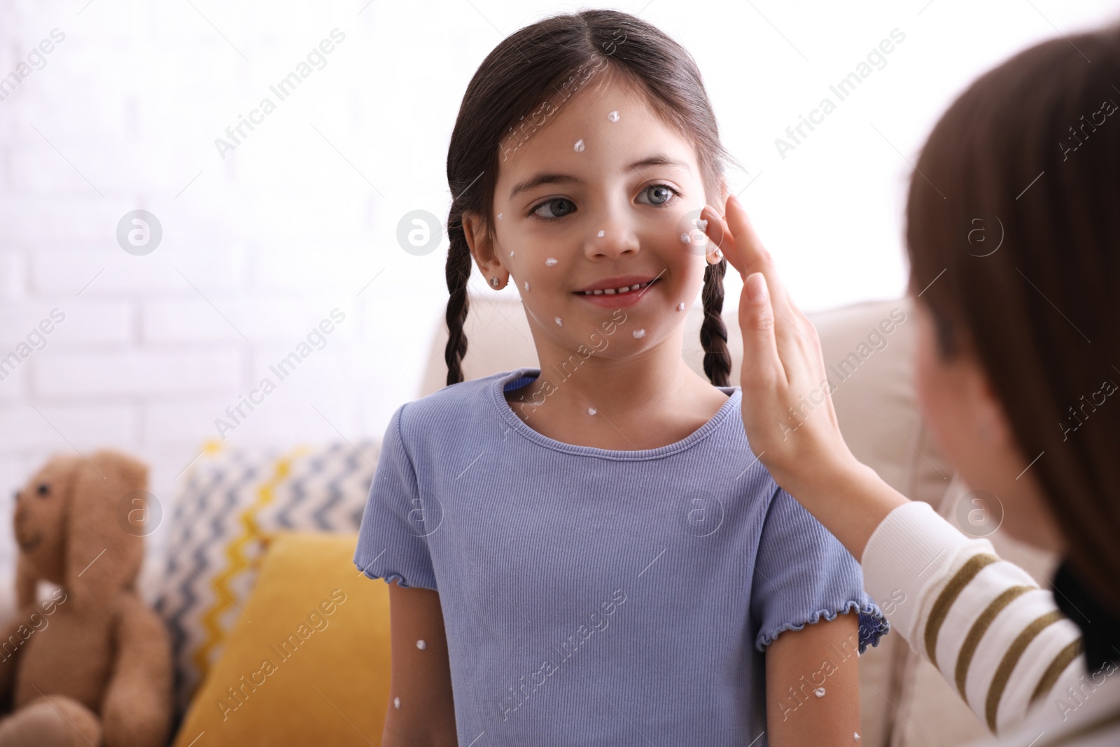 Photo of Mother applying cream onto skin of her daughter with chickenpox at home